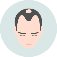 Hair Loss Landing Image